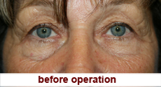 plastic-surgery-blepharoplasty